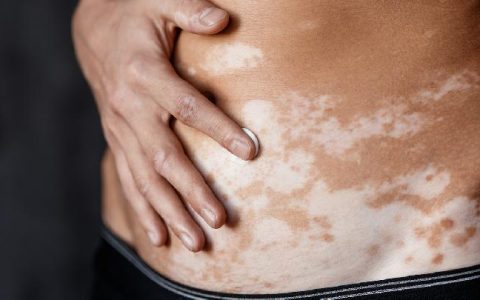白癜风发病的病因有哪些 总结几点易引发白癜风的病因
