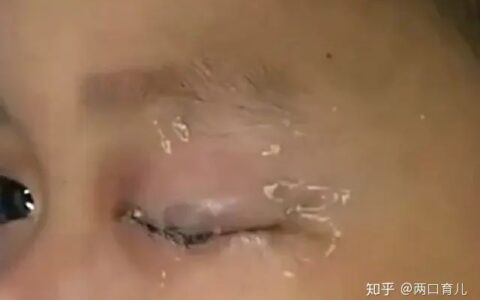 孩子误将502滴入眼睛，爸爸的应急措施，医生都大赞：幸亏处理及时
