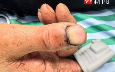 73岁婆婆被蛇咬伤 医生提醒：尽量在两小时内到医院处理-大爷被毒蛇咬伤不知道毒蛇样子